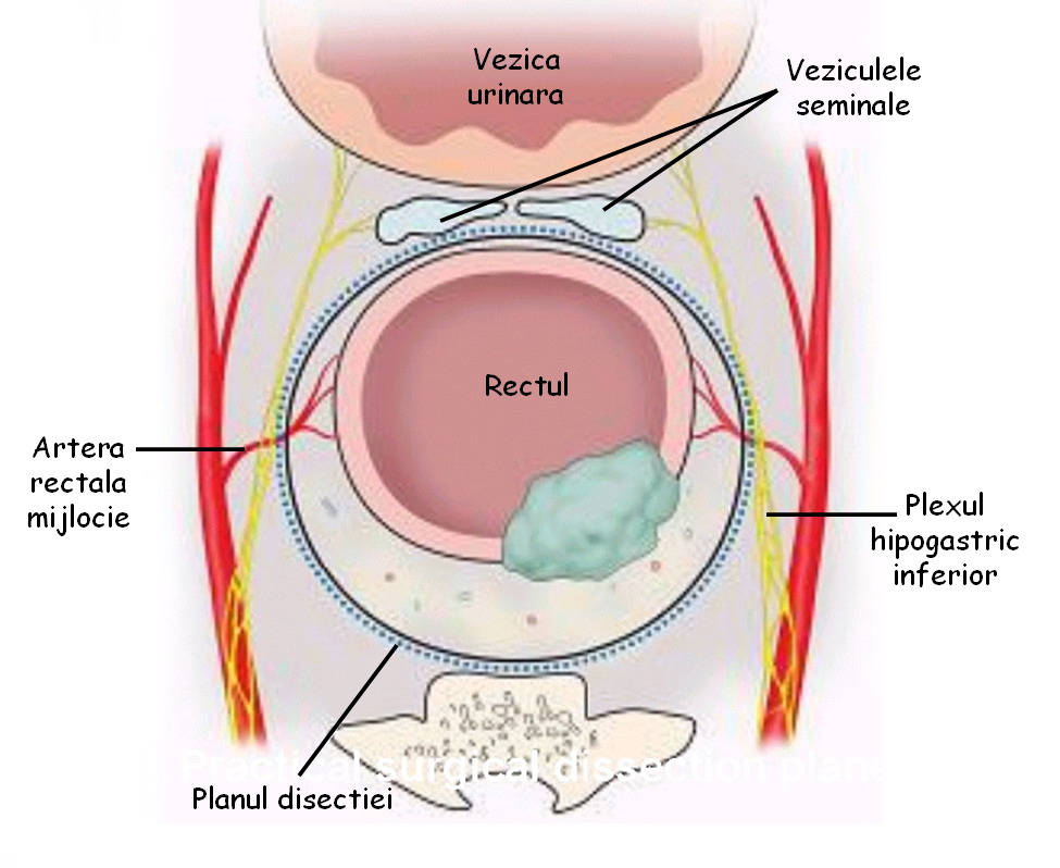 chirurgie erectie rectala